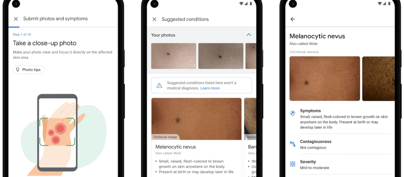 «Έξυπνο» εργαλείο της Google για εντοπισμό παθήσεων του δέρματος - Αναγνωρίζει online 288 ασθένειες